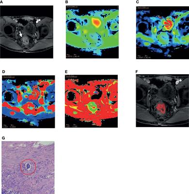 The Value of Intravoxel Incoherent Motion Diffusion-Weighted Magnetic Resonance Imaging Combined With Texture Analysis of Evaluating the Extramural Vascular Invasion in Rectal Adenocarcinoma